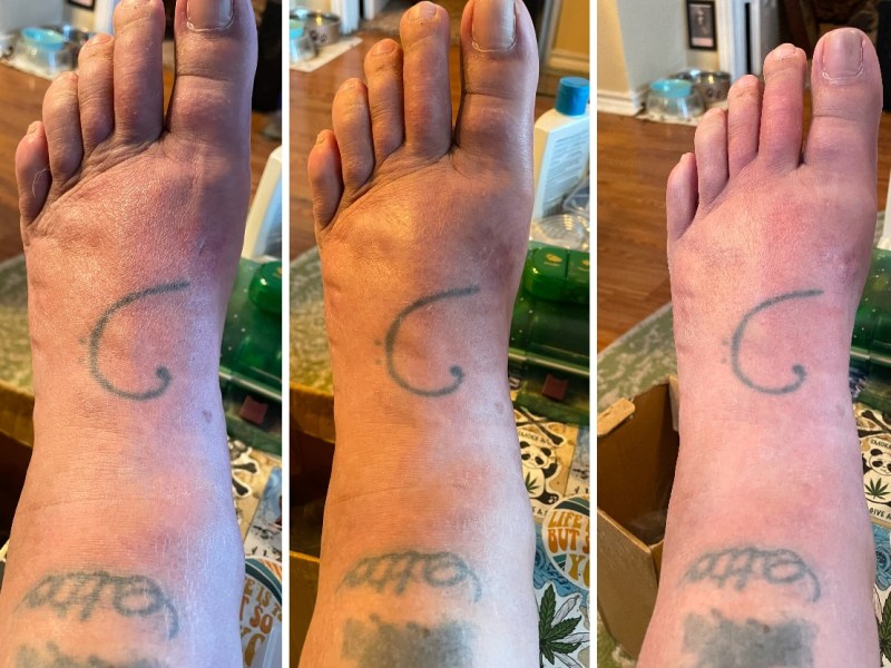 The Intensity of&nbsp;Inflammation