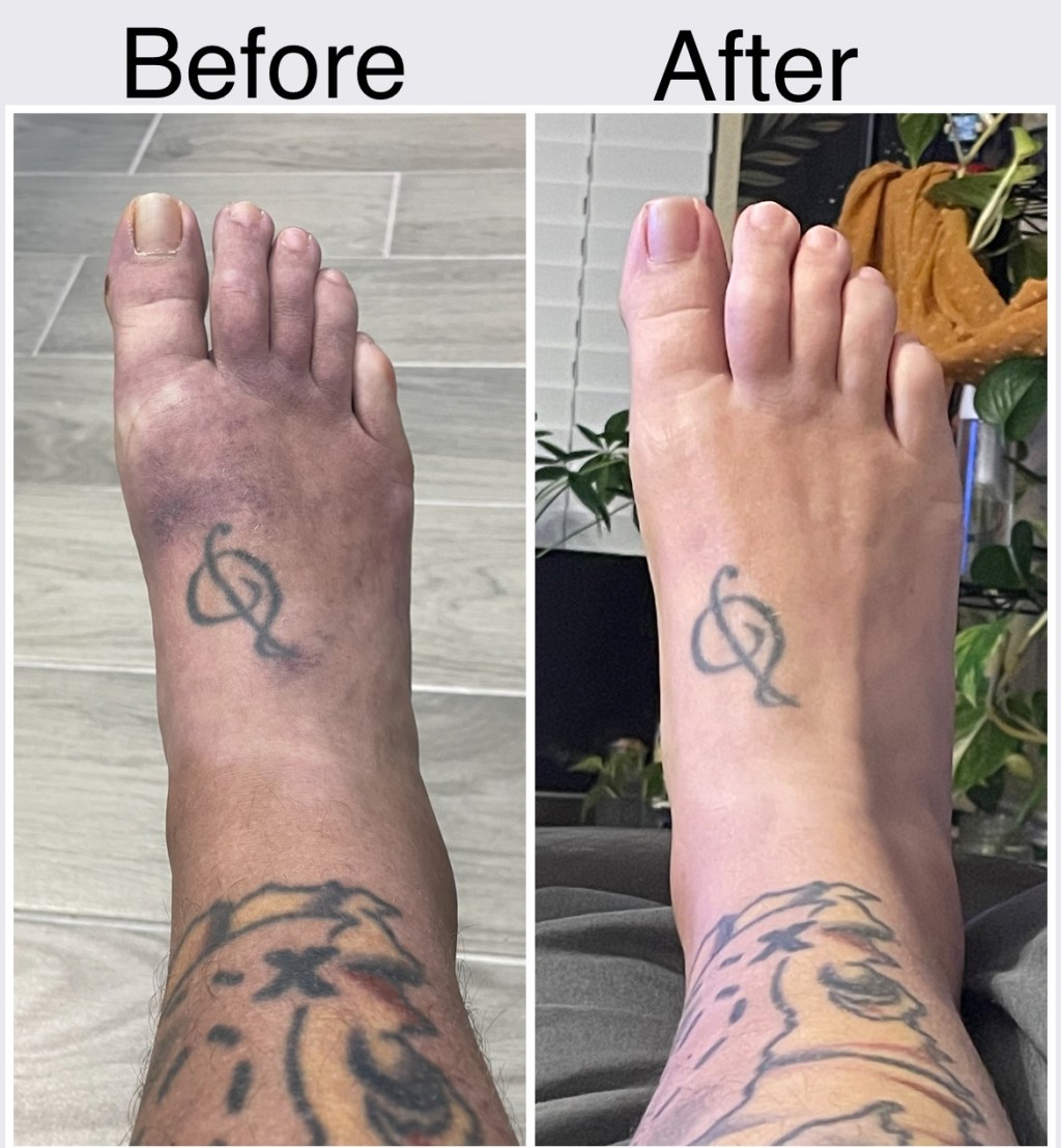 Vein Ablations and Therapy